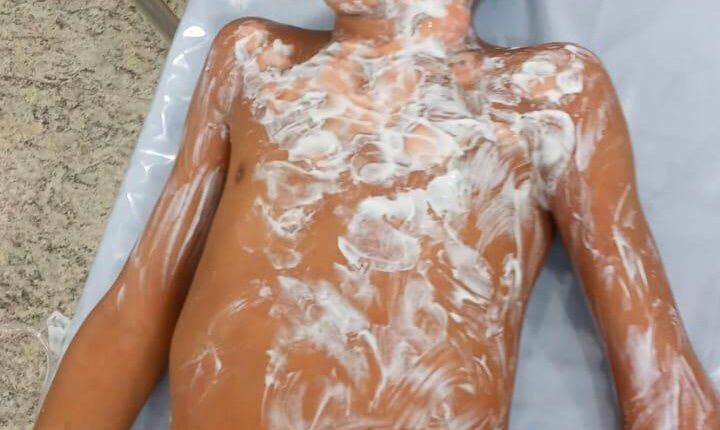 Pai nega omissão e diz que avó tentou pedir socorro ao ver menino de 8 anos em chamas